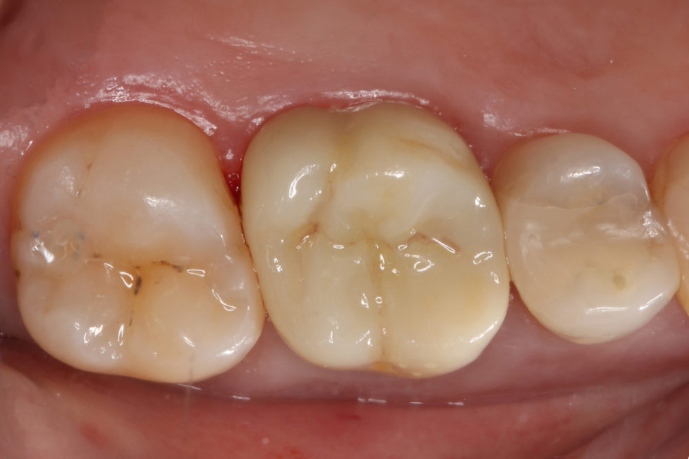 3D Dentistry: A High-tech Process with Natural Results