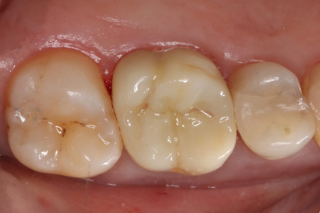 3D Dentistry: A High-tech Process with Natural Results