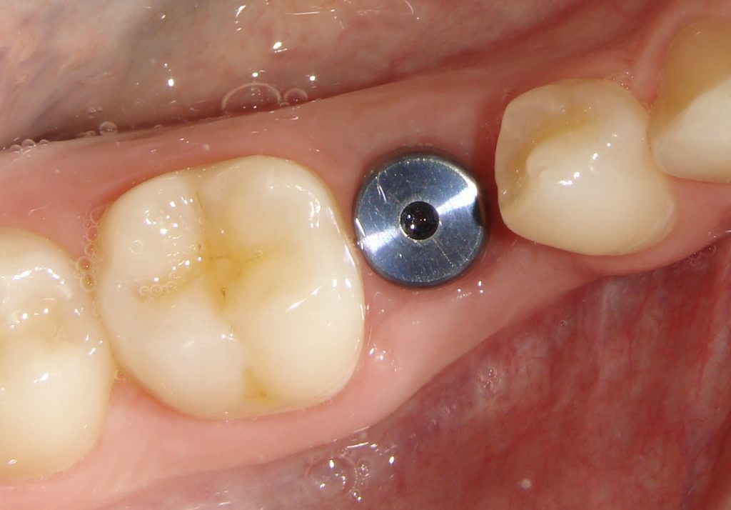 Denture Implants Winnipeg