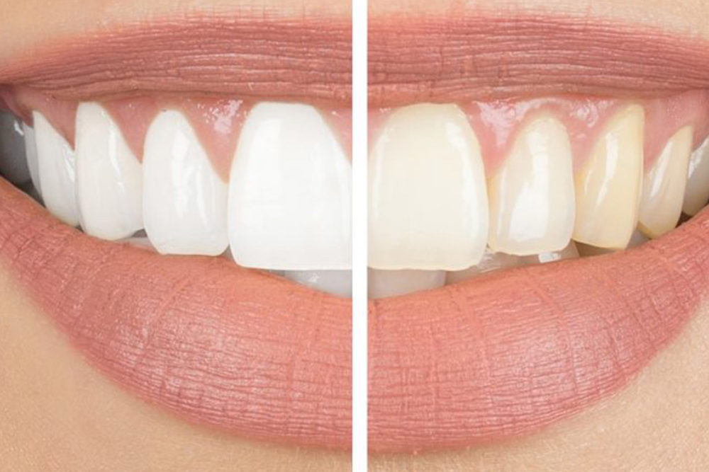 Facts vs Myths of Teeth Whitening