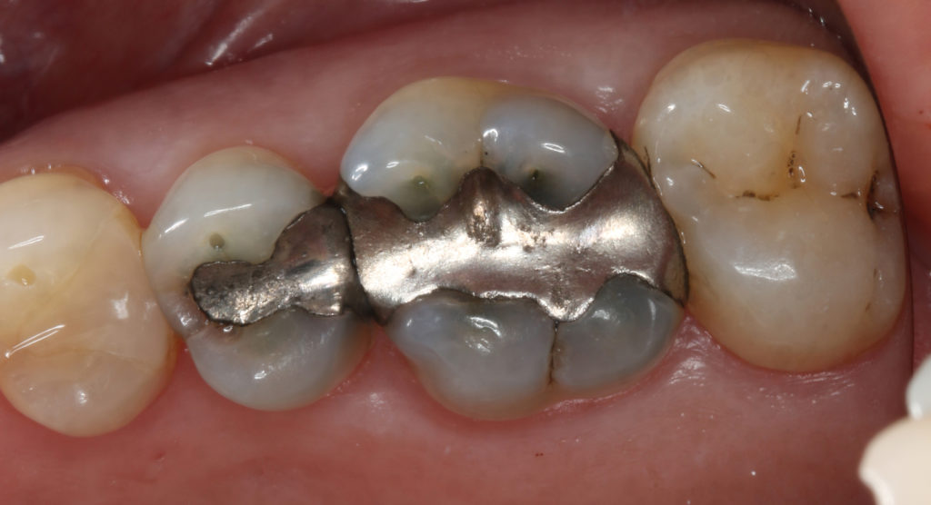 The Process of Making a Dental Crown