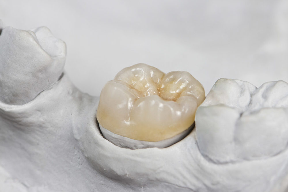 Does Every Crown Need a Root Canal?