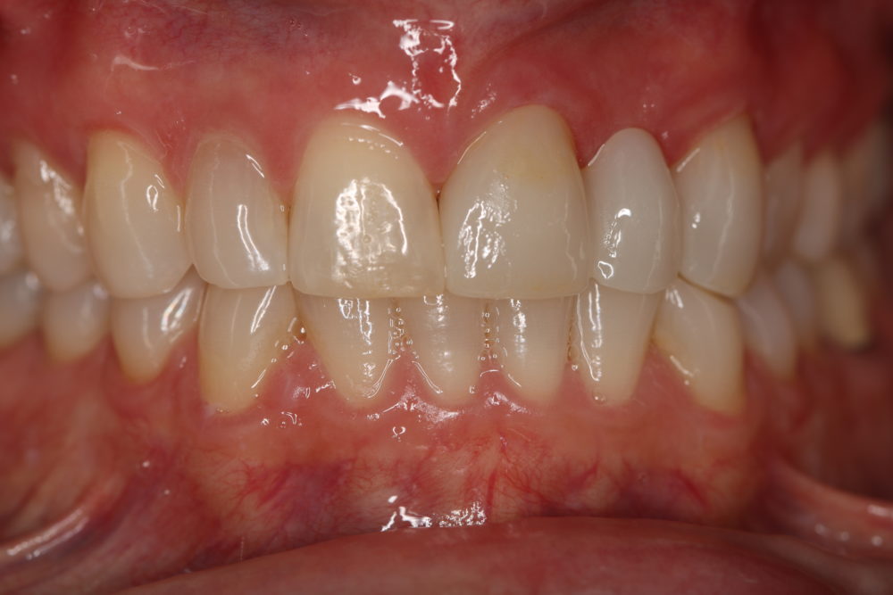 Replacing an Old Bridge Can Transform Your Smile!