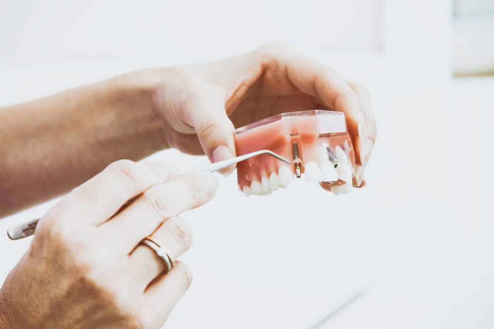 What is the Procedure for Dental Implants?