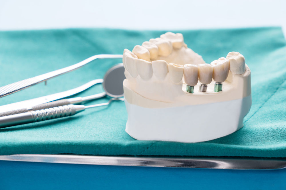 Full Fixed or Removable Dental Implant Restorations: Which is Right for You?