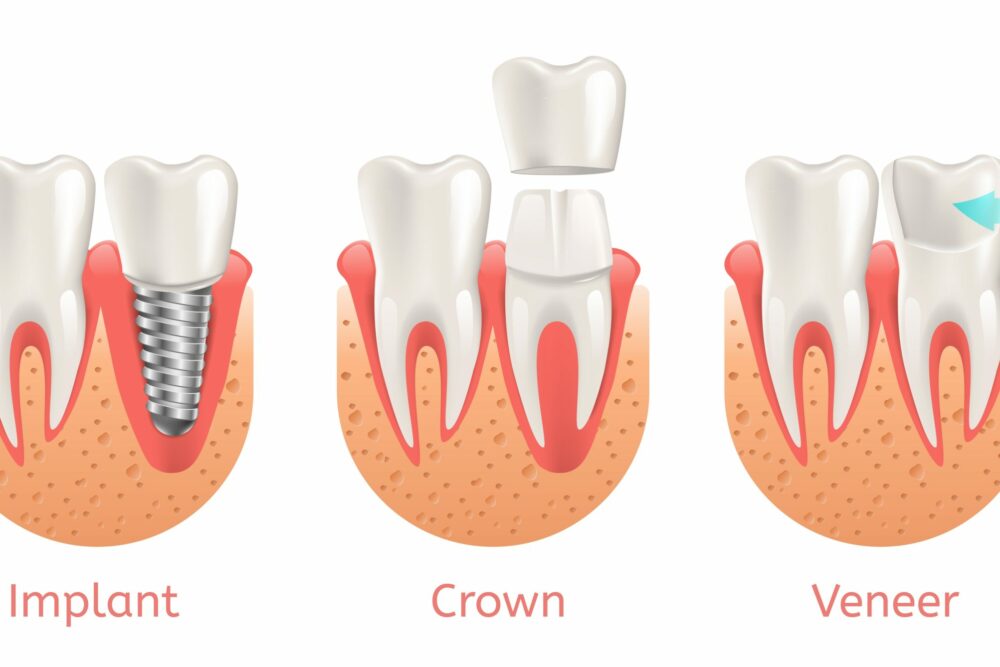 Veneers vs. Crowns vs. Implants: Which is Right for You?